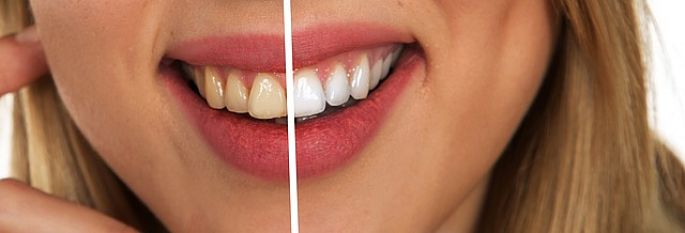 Zuby - bělení zubů